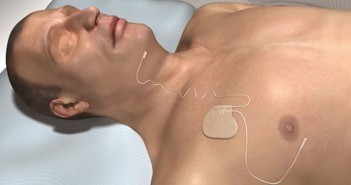 ¿Los marcapasos pueden curar la apnea obstructiva del sueño?